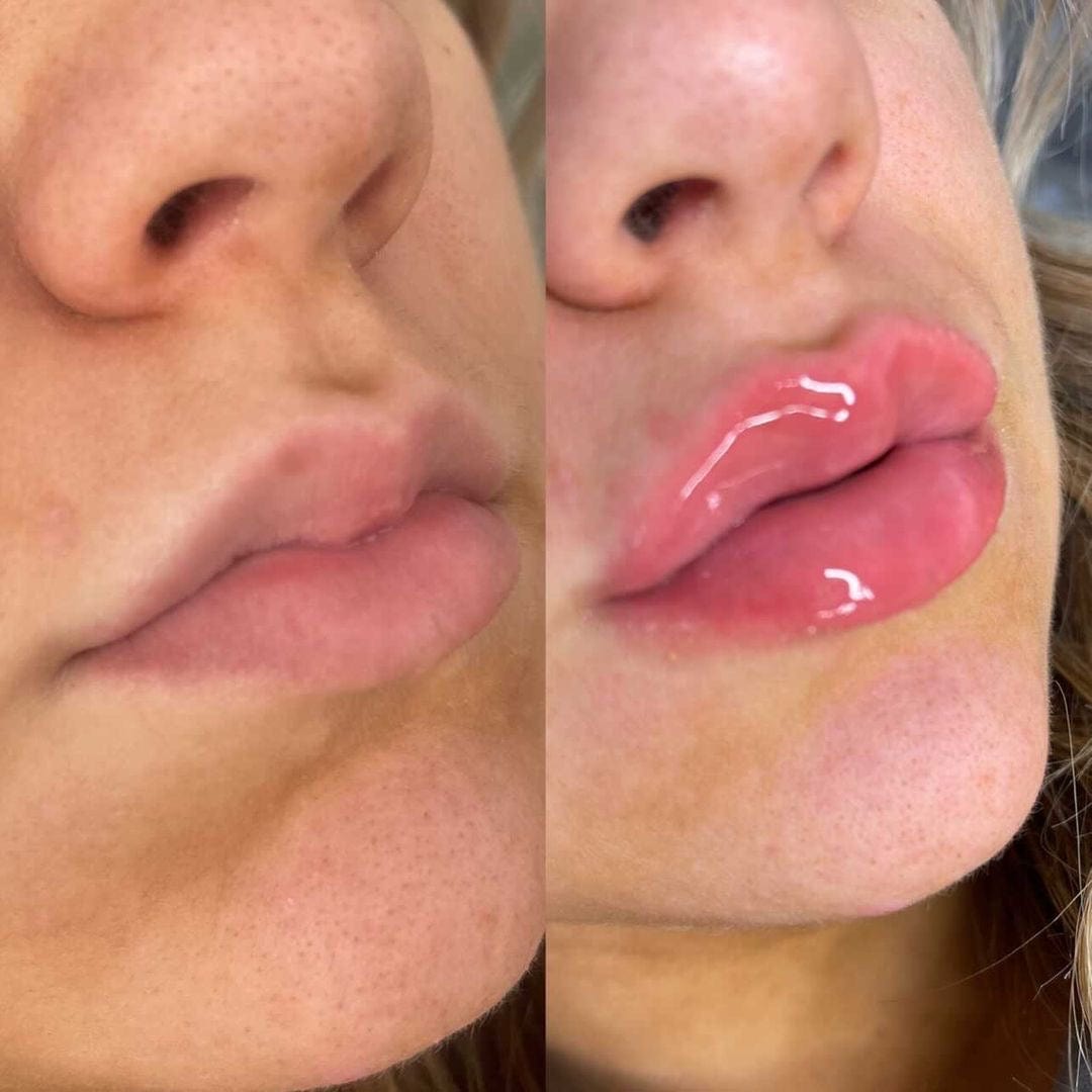Rellenador de labios voluminizador®