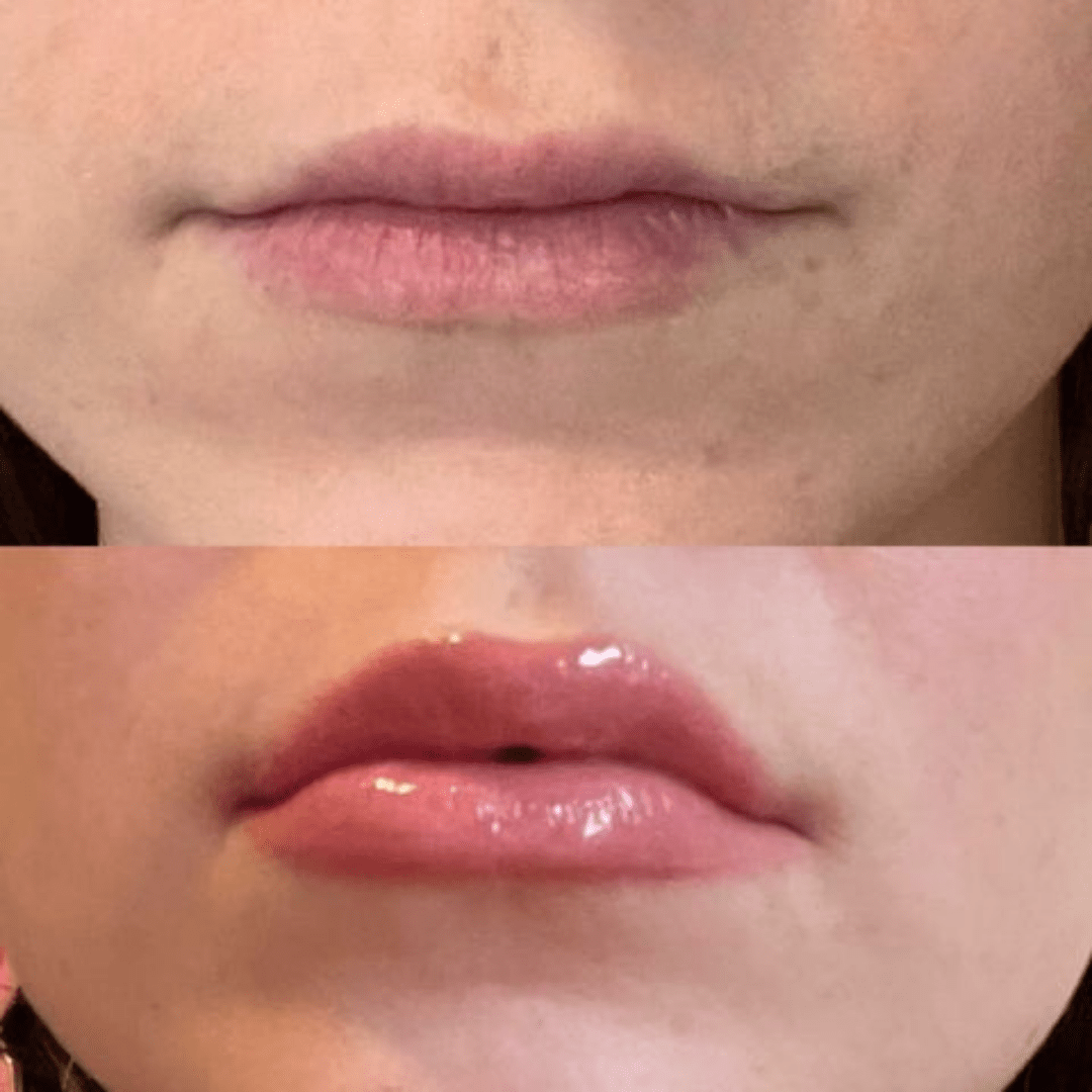 Rellenador de labios voluminizador®